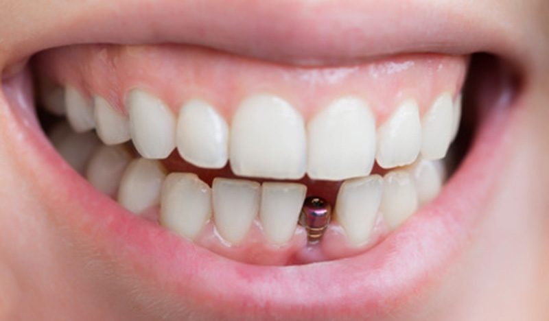 All you Need to Know About Dental Implants