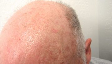 How To Find A Good Quality Practitioner For Your Scalp Micropigmentation?