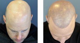 What are Scalp Micropigmentation Birmingham and its advantages?