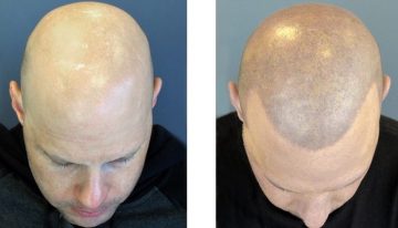What are Scalp Micropigmentation Birmingham and its advantages?