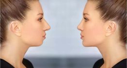 Chin Fillers in Singapore: Are Chin Fillers Worth It?